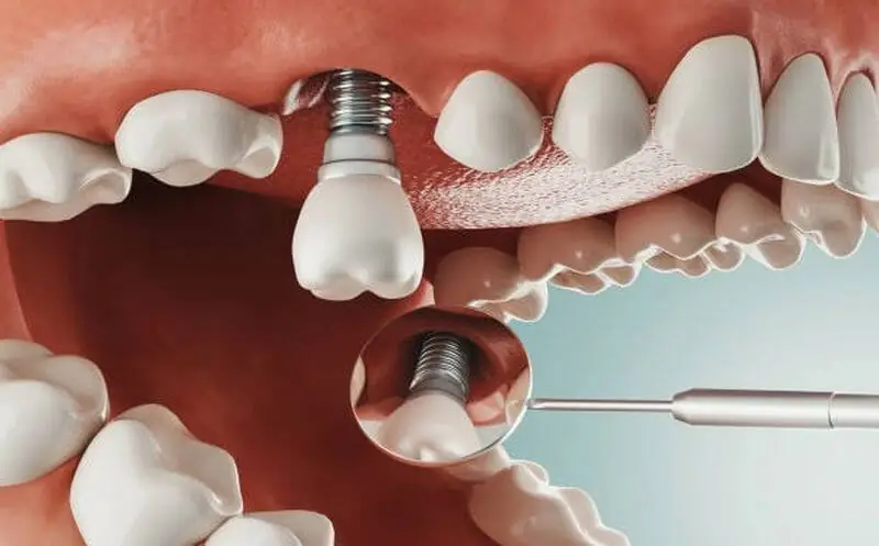 Yếu tố ảnh hưởng đến thời gian cấy implant
